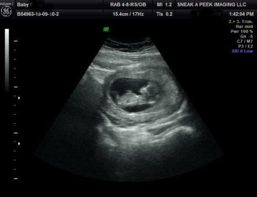 What is a 2D heartbeat ultrasound?